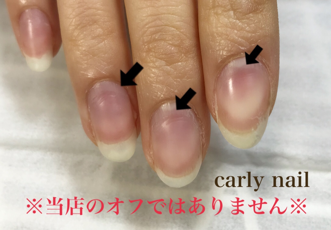 ネイリストさん必見 痛々しいボロボロネイル 泣 Carly Nail 岐阜県岐阜市の人気ネイルサロン スクールのカーリーネイル